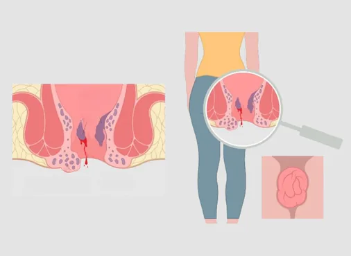 Piles Surgery - Laser vs Stapler vs Conventional consultation at Niraaya Hospital